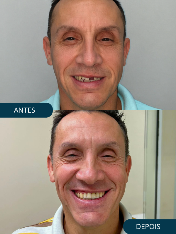 Antes e Depois - Odonto Help